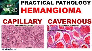 HEMANGIOMA capillary amp Cavernous Clinical features amp Morphology [upl. by Adelaida]