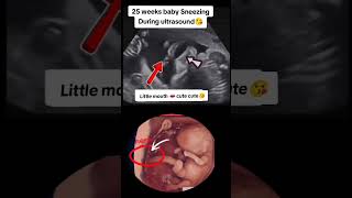 25 weeks baby sneezing during ultrasound😘😘viralvideo trending viralshorts [upl. by Uhsoj]