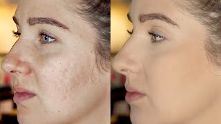 Pitted Acne Scar Makeup Tutorial Step by Step  Icepick ScarsBoxcar ScarsCraterspotmarks [upl. by Prisca]