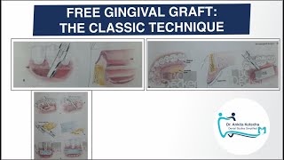 FREE GINGIVAL GRAFT THE CLASSIC TECHNIQUEPERIODONTAL PLASTIC AND ESTHETIC SURGERYDR ANKITA [upl. by Yentnuoc108]