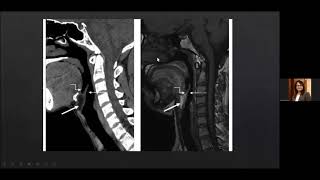 Radiological anatomy of Larynx and Hypopharynx Dr Kajari Bhattacharya [upl. by Sucy]