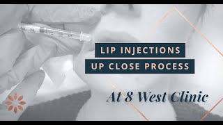 Lip Injections with Restylane Dermal Filler  8 West Clinic in Vancouver British Columbia [upl. by Granville]