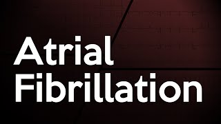 Atrial Fibrillation ECG [upl. by Eniledgam351]