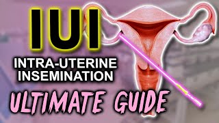 IUI  Fertility expert secrets for maximum pregnancy rates [upl. by Madella]