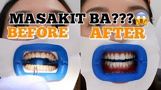 FIRST TEETH WHITENING EXPERIENCE SHOCKING RESULTS  Angel Dei [upl. by Ahsena998]