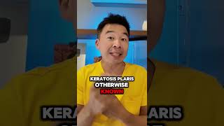 Treating Keratosis Pilaris [upl. by Atineg]