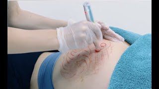 Stretch Mark removal using Microneedling [upl. by Raimondo]