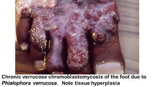 Lecture 9  Chromomycosis and Mycetoma [upl. by Salohcin]