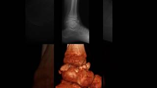 multiple intraarticular epiphyseal osteochondromas in the tibiotalar joint [upl. by Haneehs222]