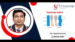 Varicose Veins  All you need to Know  DrSrikanth Raju  Vascular Surgeon  Hyderabad [upl. by Ppik35]