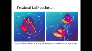 Localizing the culprit artery blockage in patients experiencing a STEMI ECG analysis  MI [upl. by Ahon]