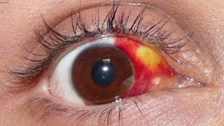 Red Eyes eye infection blood in eye  condition explained in detail eyecareoptom5506 optometry [upl. by Xanthe384]