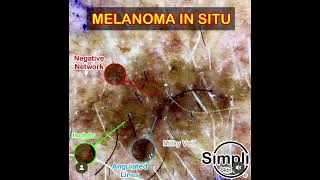 Melanoma in situ Dermoscopy [upl. by Nnorahs]