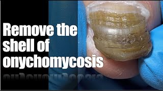 Remove the shell of onychomycosis ingrowntoenailremovalasmrRelaxing [upl. by Nawor]