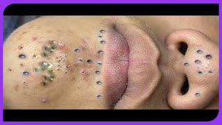 Satisfying Blackheads Removal Popping Pimples and Blackheads on Skin  2024 [upl. by Neicul609]