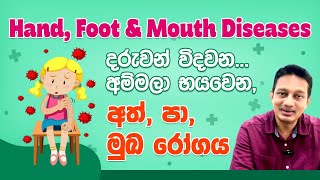 බබාලට වදදෙන අම්මලව භයකරන Hand Foot Mouth Diseaseඅත්පා මුඛ රෝගය [upl. by Minnnie659]