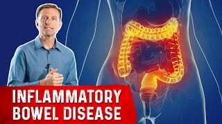 The Most Common Nutrient Deficiency in IBD Inflammatory Bowel Disease [upl. by Wise]