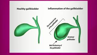 Pain Caused by Gallbladder Inflammation [upl. by Iny]