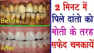 This remedy will brighten yellow dirty teeth like pearls  Teeth Whitening Home Remedies [upl. by Aihtniroc]