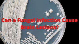 Can A Fungal Infection Cause Brain Lesions [upl. by Nnaxor]