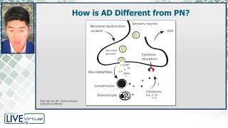 Neuroimmune Underpinnings of Prurigo Nodularis [upl. by Layol]