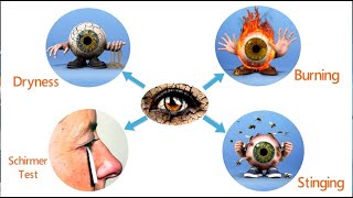 Dry Eye  Clinical Features and Investigation Within 300 Mins 34 [upl. by Sigismundo]