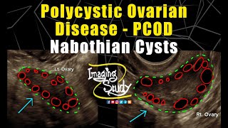 Polycystic Ovarian Disease with Nabothian Cysts  PCOD  Ultrasound  TVS  Case 256 [upl. by Atteynek564]