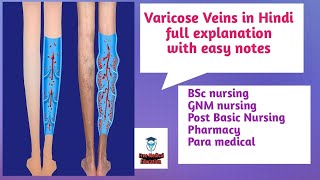 Varicose veinsfull explanation in Hindi with easy notesFreeMedicalEducationld3sfby Dr Harjass [upl. by Beauchamp250]