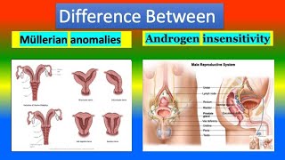 Difference Between Mullerian Anomalies Agenesis and Androgen Insensitivity [upl. by Llerrehc449]