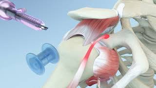 Right Shoulder Rotator Cuff Repair and Biceps Tenodesis Animation [upl. by Sang]