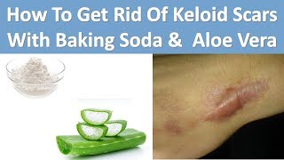 How To Get Rid Of Keloid Scars With Baking Soda amp Aloe Vera [upl. by Nanerb309]