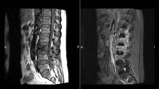 Osteomyelitis and paravertebral phlegmon [upl. by Anai]