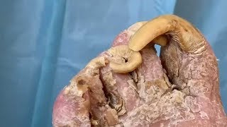 Podiatrist Tackles Thick Infected Toenails [upl. by Notnirt4]