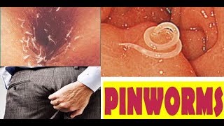 Pinworm पिनवॉर्म सम्पूर्ण जानकारी और बचाव के तरीके [upl. by Euqinad]