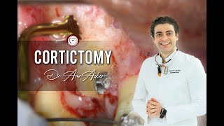 Corticotomy of impacted canine in orthodontics [upl. by Mori]