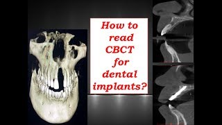 How to read CBCT for dental implants  Discussion by DrMurugavel [upl. by Teferi457]