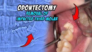 ODONTECTOMY  Dentist  Dokter Gigi Tri Putra [upl. by Aniwde]