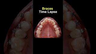 Orthodontics time lapse braces orthodontist dentist [upl. by Roi45]