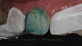 Reconstrucción dental con llave de silicona transparente [upl. by Aicnelav]