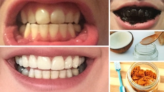 DIY 10 Home Remedies To Whiten Teeth [upl. by Namad978]