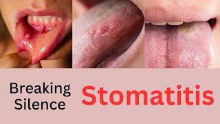 Breaking the Silence on Stomatitis  Understanding Stomatitis Causes Symptoms and Treatment [upl. by Olag3]