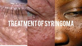 Treatment of syringoma [upl. by Scully833]