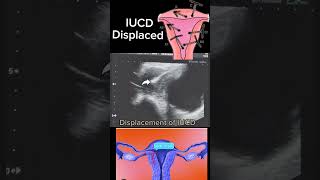 Displaced IUCD Causes Diagnosis and Management shortsbeta yt healthytips DrSaimakhan [upl. by Delores]