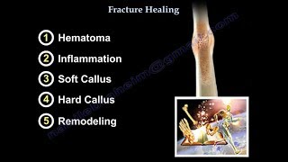 Fracture Healing  Everything You Need To Know  Dr Nabil Ebraheim [upl. by Ela996]