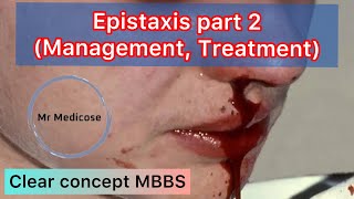 Epistaxis part 2 Management Treatment [upl. by Mendelson691]