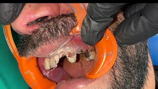 Teeth decay removal 👌🦷 TOOTH CLEANING original sound asmr asmrsounds asmr teethcleaning [upl. by Leorsiy932]