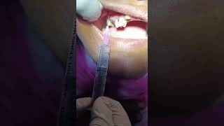 Local Infiltration anesthesia LIA  Upper Premolar  DrteethSohel semapur [upl. by Yekcor]