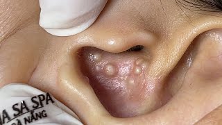 Big Cystic Acne Blackheads Extraction Blackheads amp Milia Whiteheads Removal Pimple Popping  2696 [upl. by Naasar187]