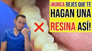 Nunca dejes que te hagan una resina dental así [upl. by Ynagoham]