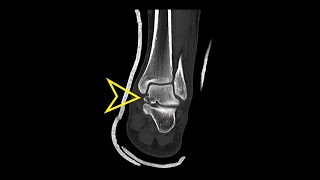 Ankle CT Talus Neck Fracture [upl. by Ahsinom580]